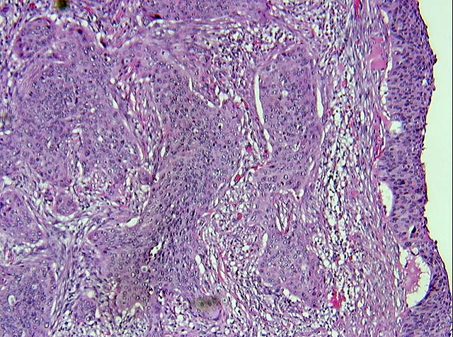  cervix including; large cell non keratinizing squamous cell carcinoma, 