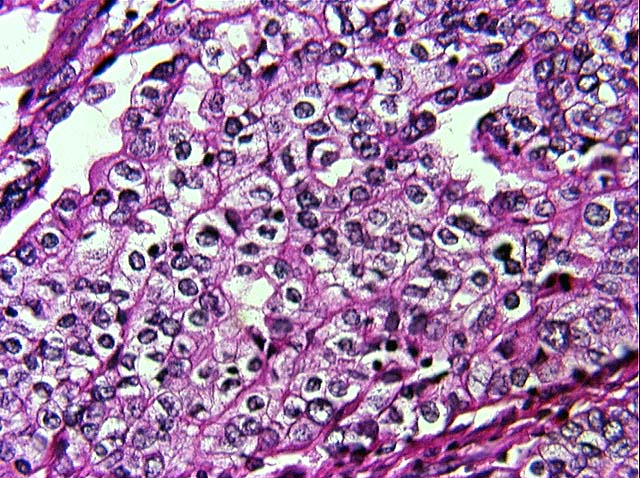 Clear Cell Syringoma