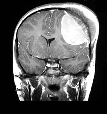 intracranial  tumor