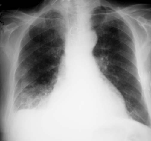 tuberculosis x ray. X-ray of the chest taken about