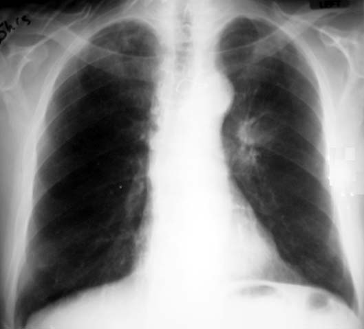 tuberculosis x ray. Compared to the chest X-ray