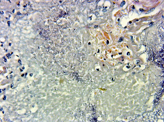 Nocardia - lung-Fite-Faraco Modified Acid Fast stain #1; 