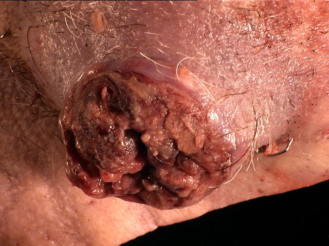 The tumor measures 4.5 x 2011