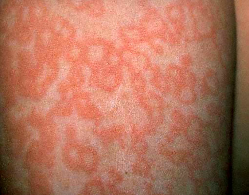 Viral causes of rashes in children - RightDiagnosis.com